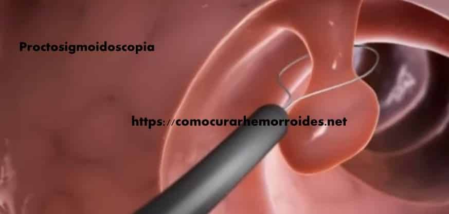hemorroides y proctosigmoidoscopia
