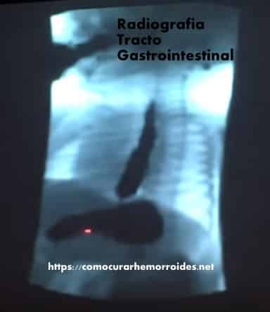 rayos X tracto gastrointestinal